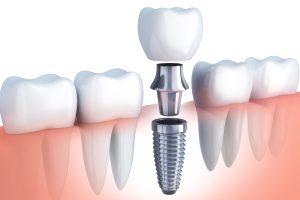 7 Enticing Ways To Improve Your Best Dental Implants in Aberdeen Skills