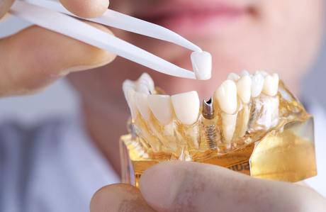 The Benefits of All-On-Four Dental Implants