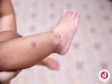 Hand Foot and Mouth Diseases in Kids: How to Recognize, Treat, and Prevent?