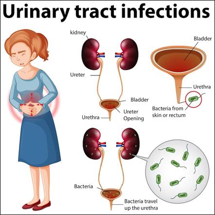 Drugs for Urinary Tract Infections – Trimethoprim/sulfamethoxazole, Fosfomycin, Nitrofurantoin & Better Alternate Remedies in Ayurveda