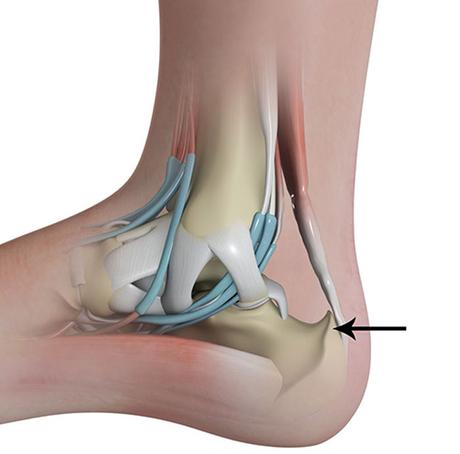 Haglund's Deformity