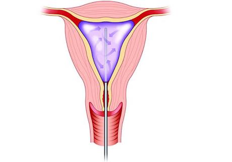 The Endometrial Lining Of The Uterus Is Removed Or Destroyed During Endometrial Ablation Surgery