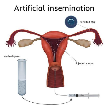 An Artificial Insemination Involves Introducing Semen Into A Female's Vagina Or Cervix By Any Method Other Than Sexual Contact