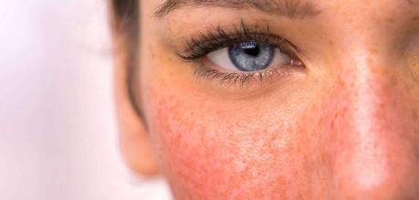 How to get rid of rosacea permanently? How to get rid of rosacea permanently?