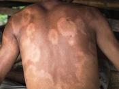 Significant Increase Leprosy Cases Recorded