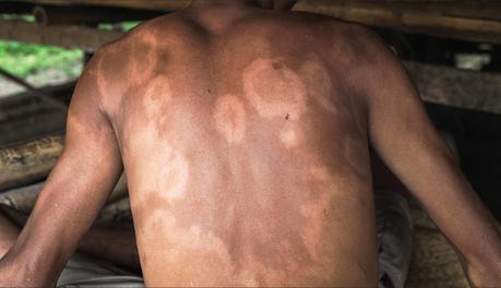 Significant increase in Leprosy cases recorded