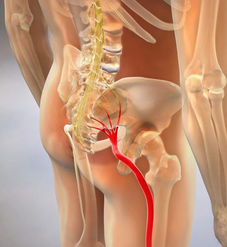 Sciatica, Causes, Signs and Symptoms, Diagnosis and Treatment 5 SCIATICA