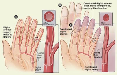 Reynaud's AKA Ice Cold Hands and Feet (and ears and nose)