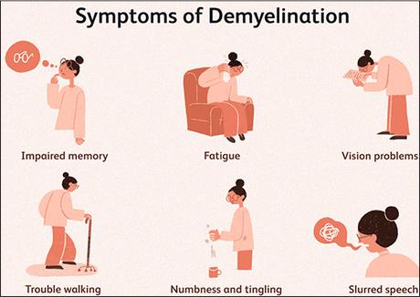 Demyelinating Diseases – Causes, Symptoms, Types and Ayurvedic Treatment