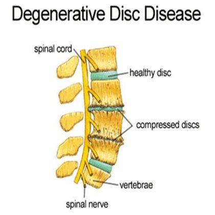 The Growing Demand For Degenerative Disc Disease Treatment Market: Analysis And Outlook