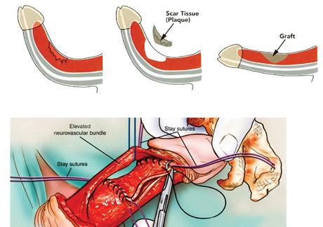 Peyronie's Disease Treatment Market: Rising Demand For Non-Surgical Therapies Peyronie's Disease Treatment Market: Rising Demand For Non-Surgical Therapies