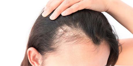 Androgenetic Alopecia Treatment Market