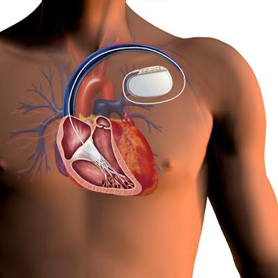 Implantable Cardioverter-defibrillators Market