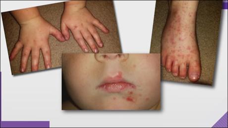 Alternative Treatment for Hand-Foot-Mouth Disease