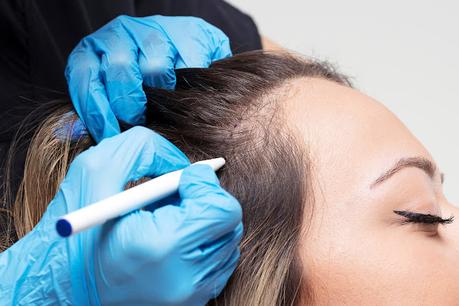 Hair Loss Treatment Market