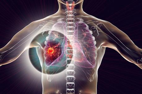 Non-Small Cell Lung Cancer: Breaking The Barriers To Treatment