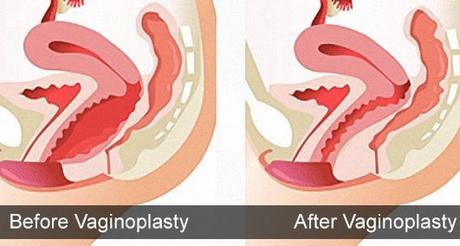 Virgin Tightening Surgery Before and After Pictures – An In-Depth Overview