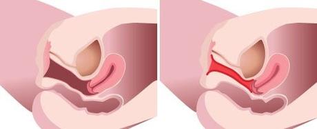 Virgin Tightening Surgery Before and After Pictures – An In-Depth Overview