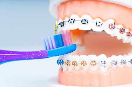 Which Are The Best Braces Colors?