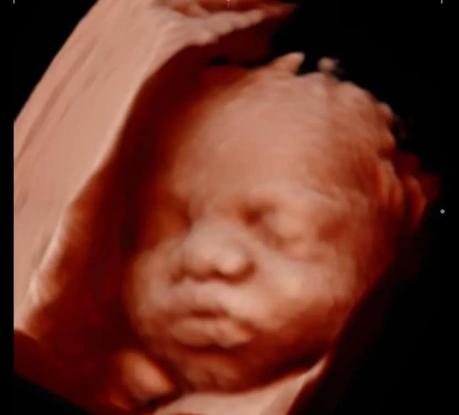 Ultrasound image showcasing baby's facial profile with prominent lips