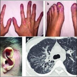 Sting Associated Vasculopathy of Infancy (Savi)- Treatment in Ayurveda