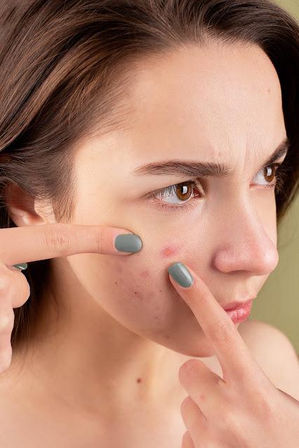 How to Effectively Deal with Pimples & Acne during the Monsoon Season