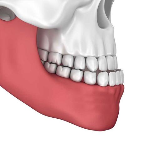 Mild Underbite vs. Severe Underbite