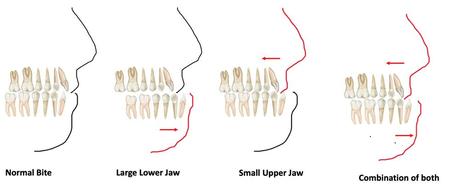 Mild Underbite vs. Severe Underbite