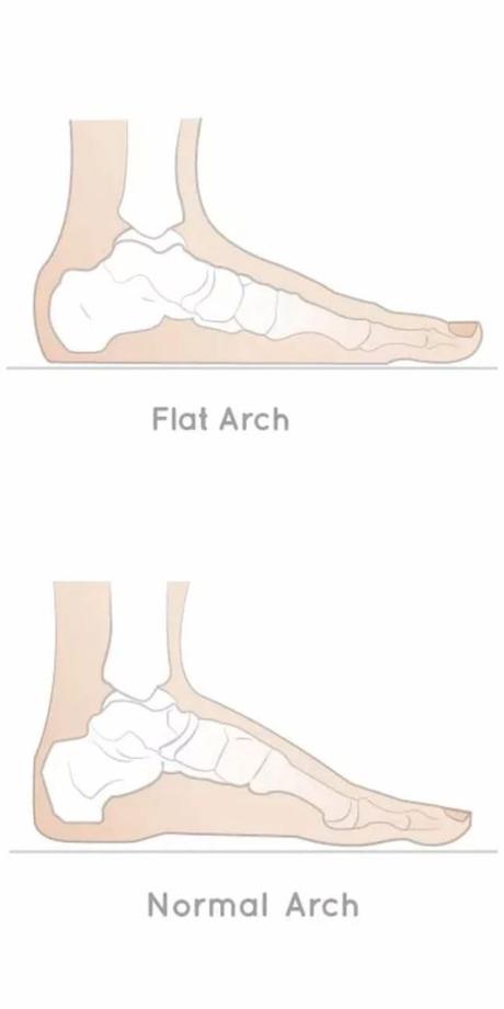Flat Feet: Symptoms, Diagnosis and Treatment - Paperblog