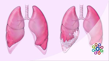 Top 10 mesothelioma law firm : Complete guide