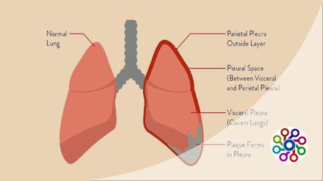 How to mesothelioma class action lawsuit settlements : Advice 2023