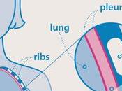 What Mesothelioma Life Expectancy Advice 2023