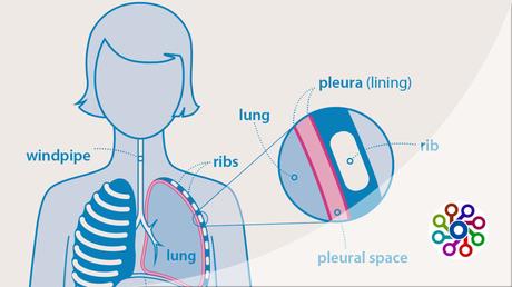 What is mesothelioma life expectancy with treatment : Advice 2023