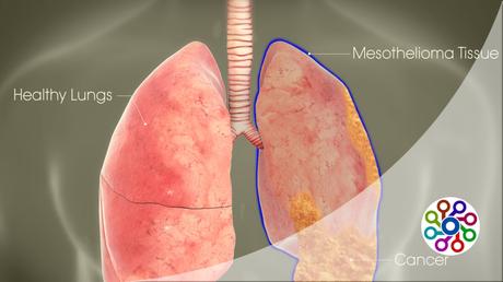 How to know cases of mesothelioma in 2023?