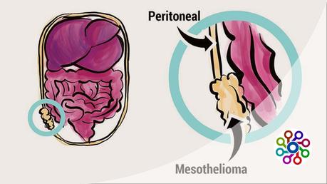 What is epithelial mesothelioma and testicular mesothelioma in 2023?