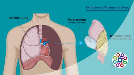 What is mesothelioma navy & testicular : Advice 2023