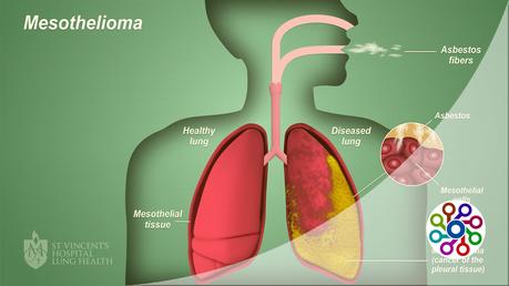 All about mesothelioma clinical trials : Advice 2023