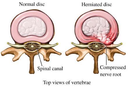 Degenerative Changes Of The Thoracic Spine