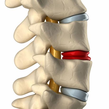 Degenerative Changes Of The Thoracic Spine