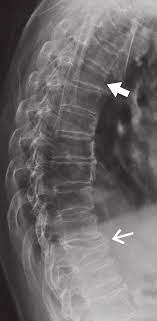 Degenerative Changes Of The Thoracic Spine