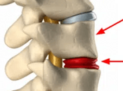 Degenerative Changes Thoracic Spine