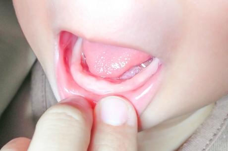 Signs of Teething in Babies