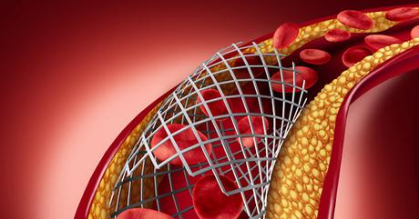 Advancements in Cardiac Care: Exploring the India Coronary Stents Market Advancements in Cardiac Care: Exploring the India Coronary Stents Market