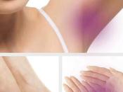 Unveiling Growth Potential Hyperhidrosis Treatment Market