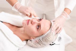 Clear and Renew: HydraFacial and Facial for Acne Scars