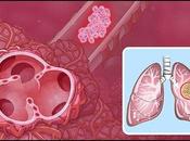 Non-Small Cell Lung Cancer Market: Unraveling Current Landscape