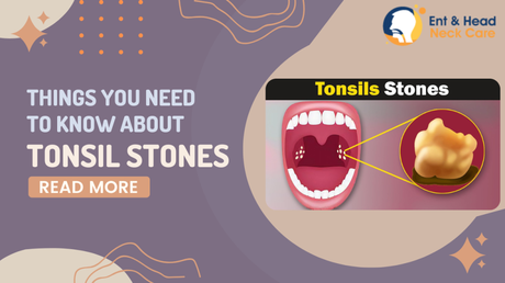 Things You Need To Know About Tonsil Stones