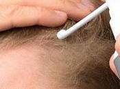 Minoxidil Market: Growth Trends Hair Loss Treatment