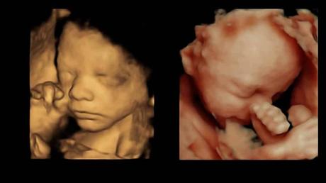 Differences Between 4D and HD Scans- Every Pregnant Woman Should Know!