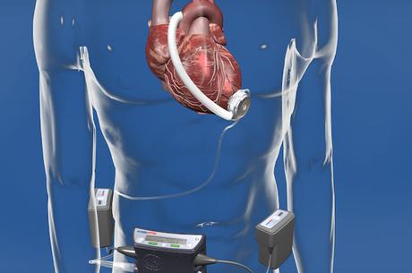 Cardiac Assist Devices Market